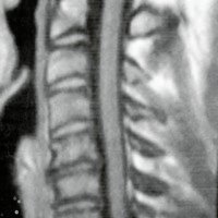 Fig. 2. IRM de columna cervical realizada a los cuatros meses, donde se observa la resolucion completa de la hernia de disco.