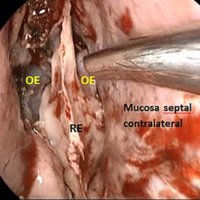 Figura 18: Septectomía posterior realizada. Se expone el rostrum esfenoidal (RE) y ambos ostiums esfenoidales (OE). A la derecha, mucosa septal contralateral.