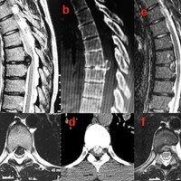 Figura 4: Paciente femenino de 28 años con con disestesias e hiperreflexia rotuliana luego de un esfuerzo. Obsérvese la hernia de disco a nivel T7-T8 anterior, calcificada (a-b-c-d) y la descompresión amplia obtenida (e-f). El paciente presentó una excelente evolución.