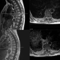 Figura 2: Caso II. Meningioma IDEM dorsal. En la fila superior corte sagital secuencia T1 (izquierda) y corte axial (a derecha) de la RMN pre-operatoria evidenciando lesión tumoral inrtradural extramedular lateral izquierda. En la fila inferior se muestra la resección quirúrgica en cortes sagital (izquierda) y axial (a derecha) con contraste. 