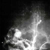 Fig. 1B. AGC derecha mostrando una MAV de ganglios basales irrigado por las arterias lentículo estriadas. Signo angiográfico de estallido de granada en el punto de implantación del meningioma.