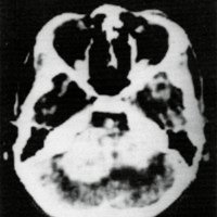 Figura 4. Neurinoma bilateral del acústico en un niño con una enfermedad de von Recklinghausen.