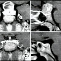 Fig. 3. Macroadenoma hipofisario, imágenes ponderadas en T1 tras la administración de gadolinio. A y B: cortes coronal y sagital preoperatorios. C y D: cortes coronal y sagital a los tres meses postoperatorios. Obsérvese la presencia de la hipófisis normal y la reabsorción completa intraselar y parcial a nivel del seno esfenoidal.
