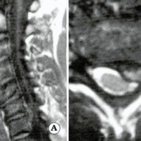 Fig. 1 IRM donde se aprecia la voluminosa hernia de disco, extruida y paramediana izquierda, a nivel C6 / C7.