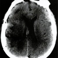 Fig. 3. TAC de cerebro postoperatoria que descarta resangrado y muestra edema post quirúrgico.