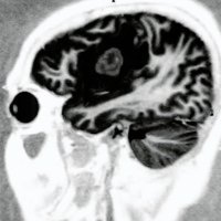 Fig. 2. IRM que muestra una lesión isointensa (TI) frontal.