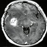 Fig. 6. Volumetría tumoral