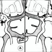 Fig. 1. Representación esquemática de un corte coronal de cerebro a nivel de la arteria comunicante anterior.