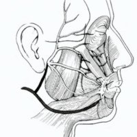 Fig. 5. Técnica de May. Uso de injerto (negro) para unir cabo distal del facial (blanco) con nervio hipogloso (gris) no seccionado.