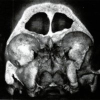 Fig. 2. Visión frontal de las cavidades orbitarias y su relación con las fosas nasales, senos maxilares y frontales y laberinto etmoidal,