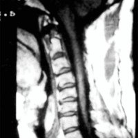 Fig. 4. Postoperatorio del mismo paciente de la figura 3, donde se realizó la craniectomía de fosa posterior con plástica de duramadre con fascia lata y la resolución de la cavidad siringomiélica.