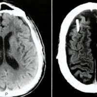 Fig. 4. TAC de cerebro. Control postoperatorio de shunt subduroperitoneal y craneoplastía que evidencia resolución de HEA.