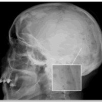 Fig. 3. Caso 4: lesiones osteolíticas múltiples. Diagnóstico de mieloma múltiple con infiltración ósea.