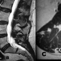 Figura 4: A y B: RMN, 2° año de posoperatorio, cortes sagitales T1 y T2. C: T1 axial con contraste. 
