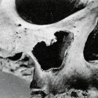 Figura 1. Cráneo seco: antrotomía máxima hasta el foramen infraorbitario. 