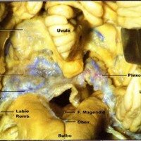 Fig. 4. Fisura cerebelobulbar. Se expone la union lelovelar. La tela coroidea izquierda ha sido removida.