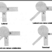 Fig. 12. Clasificación de los aneurismas cerebrales según Hassan et al (29) para su estudio mediante dinámica de flujo computacional.