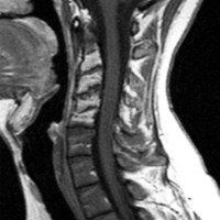 RM  columna cervical 20 meses de seguimiento. Secuencia T1 con gadolineo. Corte sagital. Pérdida parcial de la lordosis cervical, no se observa realce en los discos C2 - C5 tras él contraste. 
