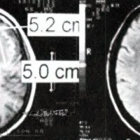 Fig. 2. IRM de cráneo: refuerzo periférico en T1 con contraste y alta señal en flair.