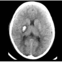 Fig. 2. Tomografia computada donde se observa hematoma en región lenticular derecha con edema perilesional.