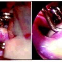 Fig. 3. Vista intraoperatoria. Reconstrucción de la pared de ICA con tres clips bajo vista microscópica. Simultáneamente el control endoscópico del clipado, mostró preservación del vaso principal.