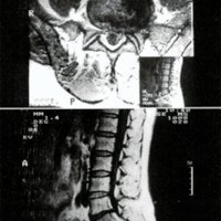 Fig. 4. Cortes axiales y sagitales de IRM ponderados en T1 informados como extrusión discal. Con la cirugía se encontró una procidencia del anillo fibroso. El intervalo IRM-cirugía fue de 60 días.<br />
