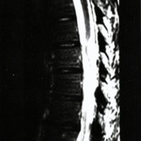 Fig. 2. Caso 2. IRM. Proyección sagital.Nótese la aracnoiditis, la presencia de quiste aracnoidal posterior. siringomielia y mielomalacia.