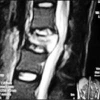 Fig 3. Tumor vertebral secundario. IRM en T2.
