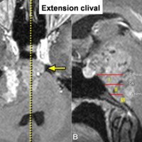Figura 8: Extensión clival. A) La línea amarilla marca la línea media. Se observa el tumor pasando al clivus contralateral, en la cara posterior del seno cavernoso contralateral. B) Se observa el tumor extendiéndose en la 3 zonas del clivus.