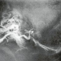 Figura 2. B. : muestra el compromiso de la luz de la carótida cervical y el aneurisma de sifón supraclinoideo. 