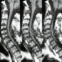 Fig. 3. IRM cervical: múltiples lesiones por AR, luxación subaxial y destrucción odontoidea.