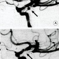 Fig. 5. A. Angiografía digital de la arteria carótida interna que muestra un aneurisma pequeño de cuello pequeño. B. Control postembolización que muestra una oclusión tipo A.