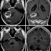 Figura 4: Hemangioblastoma sólido-quístico. A y B, RM pre operatoria. C y D, RM post operatoria.
