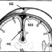 Fig. 8. Dibujo donde se observa la relación del seno sagita superior (SSS) con la sutura sagital (SG) utilizada frecuentemente en abordajes de línea media como referencia del seno. También se muestra su relación con la hoz del cerebro (HC) y ventrículos laterales (VL), estructuras abordables por línea media.