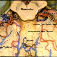 Fig. 1. Superficie cisternal de la parte superior del techo del cuarto ventriculo y fisura cerebelomesencefalica.