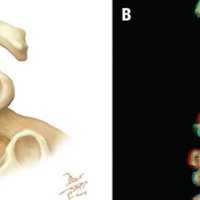 Figura 7: A: Osteotomía grado 6. B: Fotografía 3D de la Osteotomía grado 6.