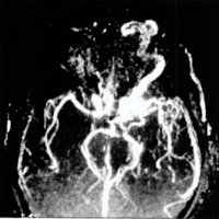 Fig. 21. Angiografia por Resonancia del mismo caso de la fig. 19 muestra dilatación del seno cavernoso y arterialización de la vena oftálmica (flecha)