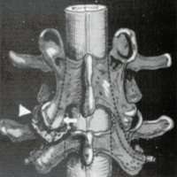 Figura 4. Estenosis dei receso iaterai. Esquema que muestra la hipertrofia de la faceta articular superior (cabeza de flecha) y su acción compresiva sobre la raíz representada por línea punteada (flecha).<br />
