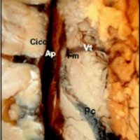Fig. 5. Preparado anatómico donde se muestra el plexo coroideo (Pc) transcurriendo por el ventrículo lateral derecho en busca del foramen interventricular (Fm), y su íntima relación con la vena talamoestriada (Vt) así como también con la arteria pericallosa (Ap) y la circunvolución del cíngulo (Cicc).
