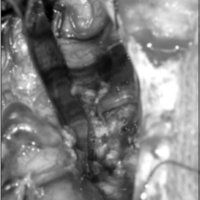 Fig. 15. Imagen intraoperatoria de la MAV de la figura 14. Se observa exéresis total de la lesión.