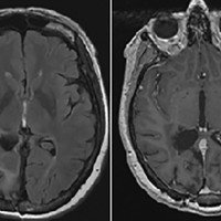 Figura 3: Resonancia magnética de control postoperatorio (22 meses) correspondiente al paciente de la figura 1 (meningioma atípico). Se objetiva lodge quirúrgica y ausencia de recidiva tumoral.