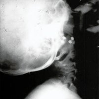Fig. 1. Rx de columna cervical (perfil) que muestra la exagerada hiperlordosis.