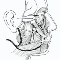 Fíg. 6. Técnica de Arai. Sección longitudinal del hipoglo so y anastomosis de un cabo con el facial mientras que el otro continúa inervando la hemilengua.