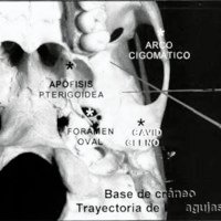 Fig 3. Base de cráneo y trayectoria de las agujas.
