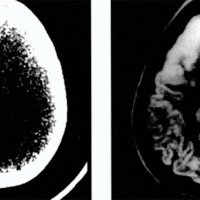 Figs. 3 y 4. TAC y IRM de cavernoma córtico subcortical frontal izquierdo confirmado por cirugía. Nótese que en la TAC el cavernoma es isodenso al tejido cerebral, no slendo visualizado, mientras que en la IRM se identifica la imagen hiperintensa de la hemorragia antlgua y el halo de hemosiderina.