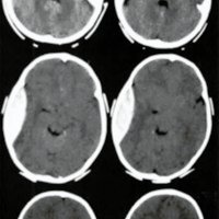 Fig. 1. Paciente asintomático: 4 días de evolución al ingreso. Fue operado por la imagen de la TAC.