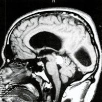 Fig. 2. IRM de cráneo sagital en T1 . Imagen con hipersenal a nivel de la lamina cuadrigemina.
