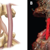 Figura 8: A: Osteotomía grado 7. B: Fotografía 3D de la Osteotomía grado 7.
