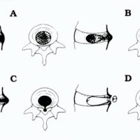 Comparación entre las Imágenes por Resonancia Magnética y los Hallazgos Quirúrgicos en la Discopatía Lumbar
