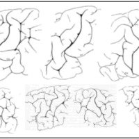 Fig. 1. Diversas formas de cisura cenral según Retzius1. La rodilla posterior frecuentemente es visible en la superficie, pero a veces es una estructura más acusada en la profundidad de la cisura.